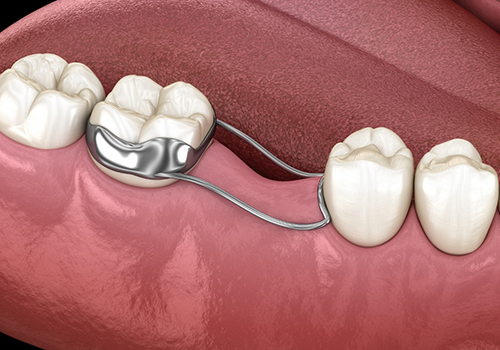 Illustration of a wire device attached to one tooth and extending past the empty space to the next tooth