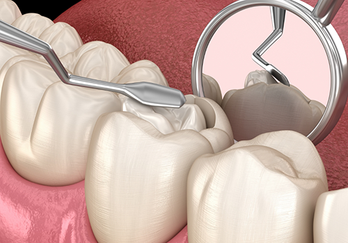 Illustration of dental instruments accessing and treating the center of a tooth