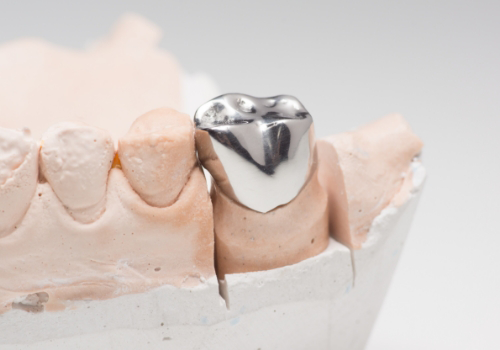 Silver dental crown covering a tooth in a model of the mouth
