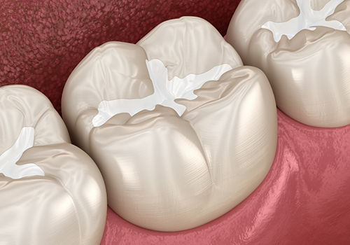 Illustration of a tooth with a white filling