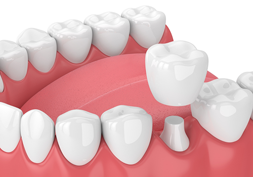 Illustration of a gray dental crown being fitted over a tooth