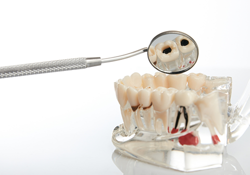 Dental mirror reflecting a decayed tooth in a model of the teeth