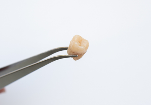 Tweezers holding an extracted tooth